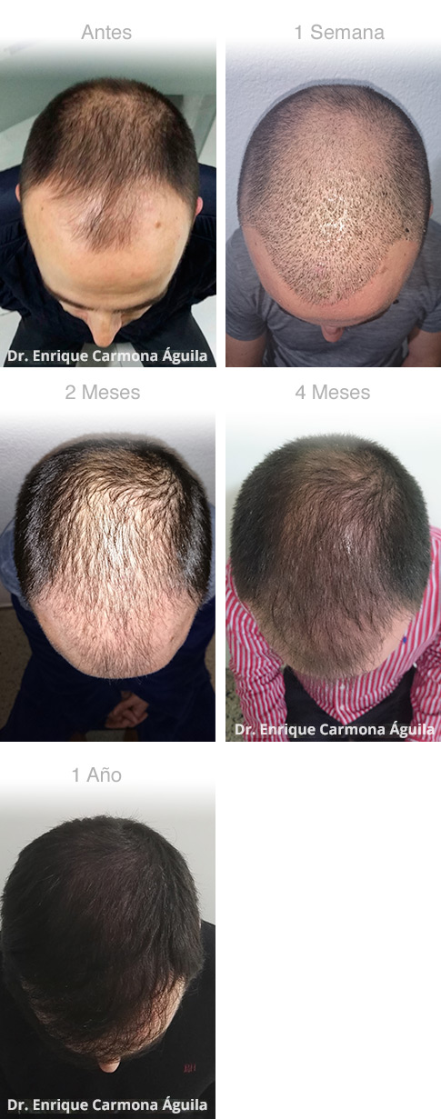 Evolución de un año Técnica de trasplante de pelo - FUE