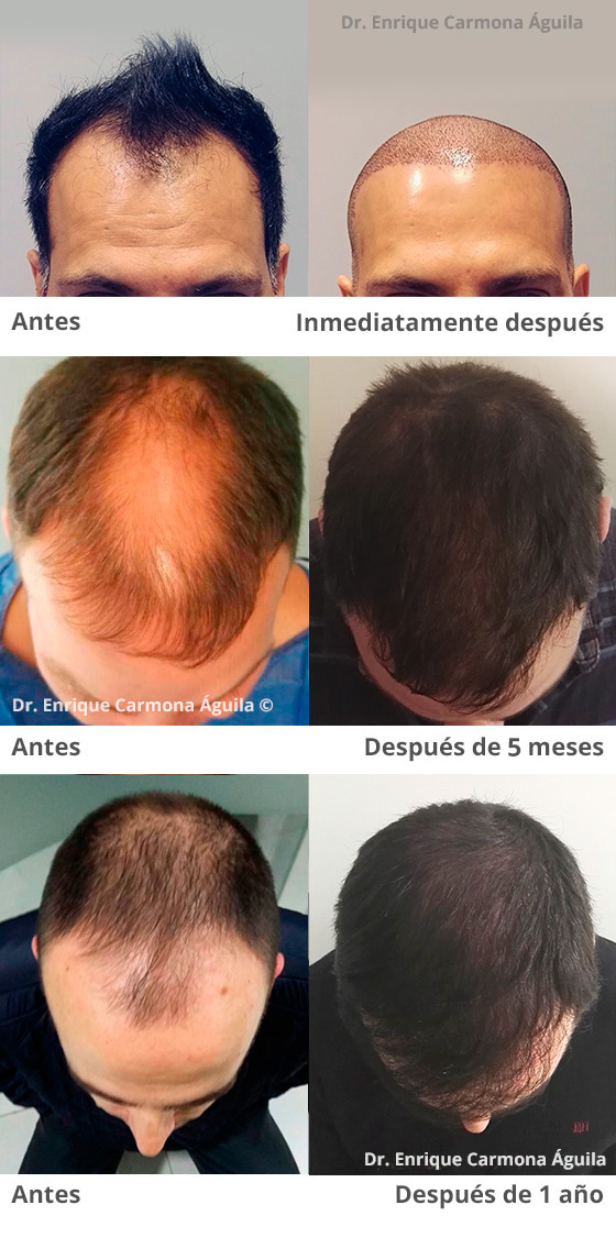 Resultados Técnica de trasplante de pelo - FUE
